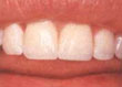 Después de la restauración dental