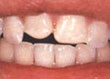 Antes de la restauración dental
