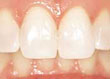 Blanqueamiento dental