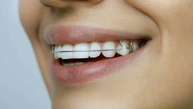 Cómo alinear los dientes sin utilizar brackets