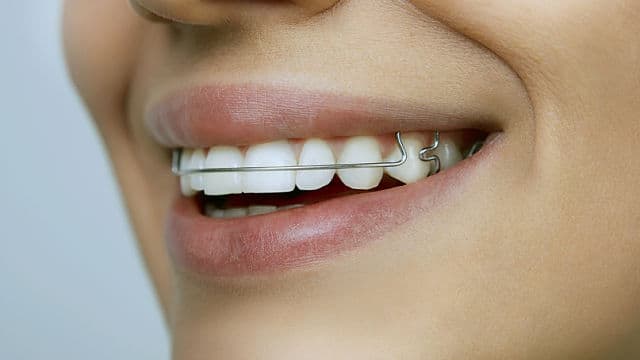 Alinear los dientes sin utilizar brackets