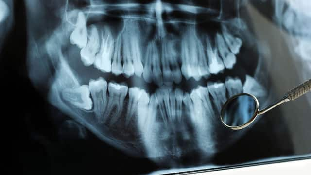 Medicación recomendada tras una extracción dental en 3 pautas - DentalBarón