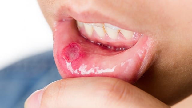 Infecciones bucales frecuentes