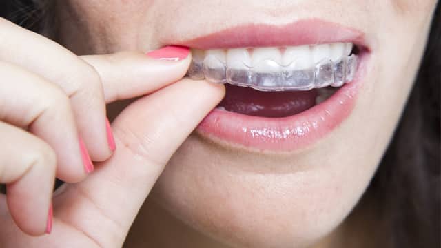 Cuatro pasos para reparar un bracket de ortodoncia roto